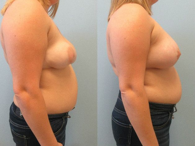 Breast Asymmetry Before & After