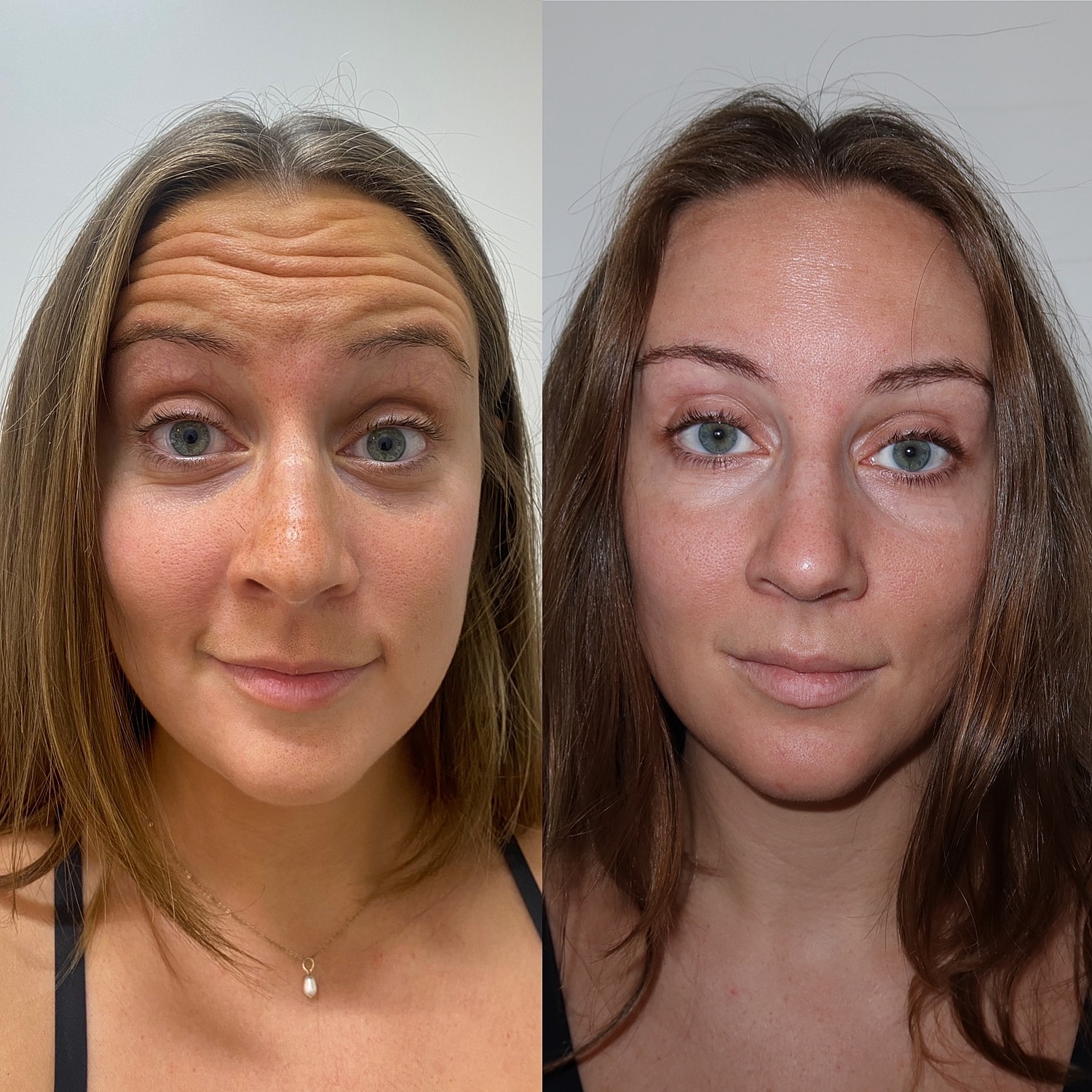 Botox Before & After