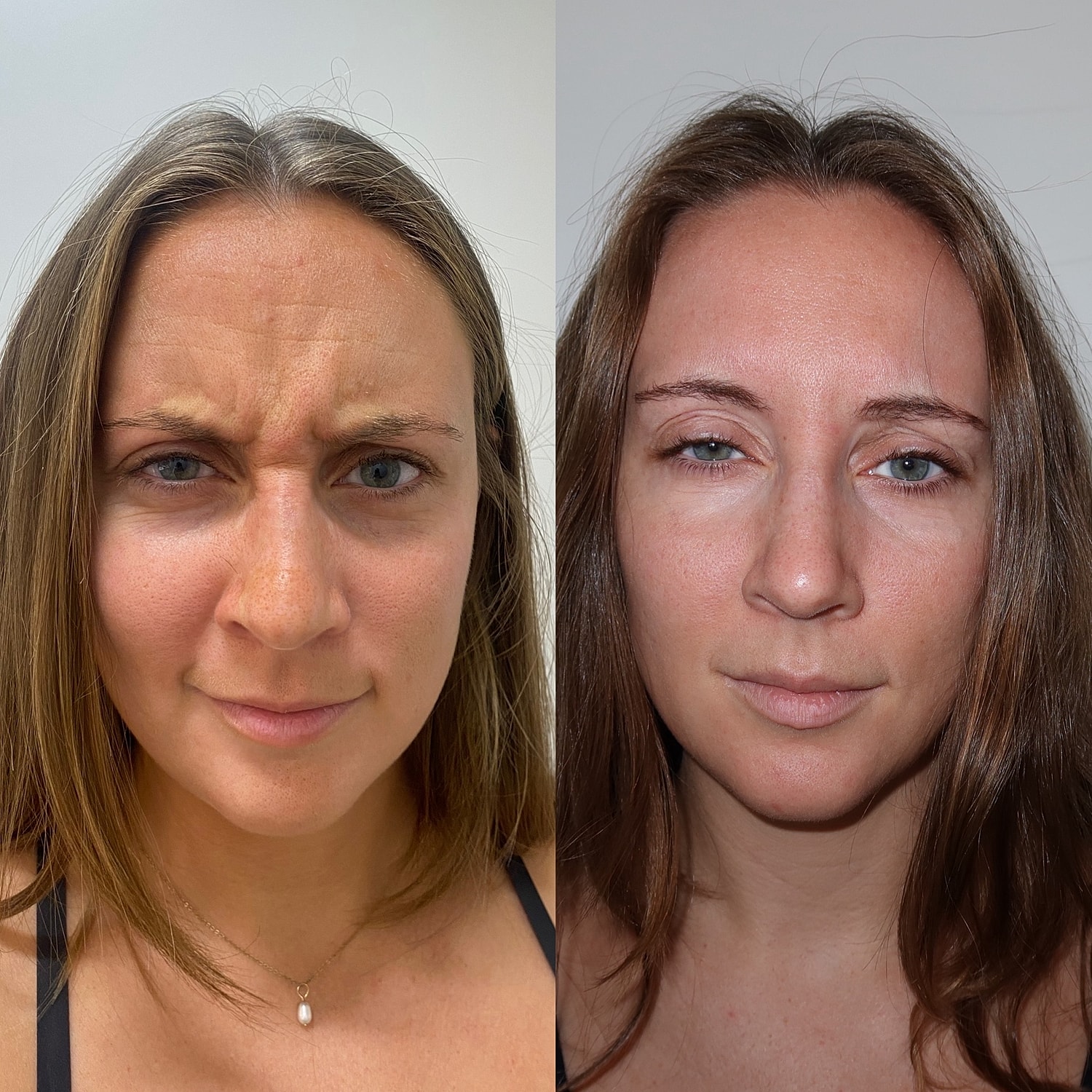 Botox Before & After