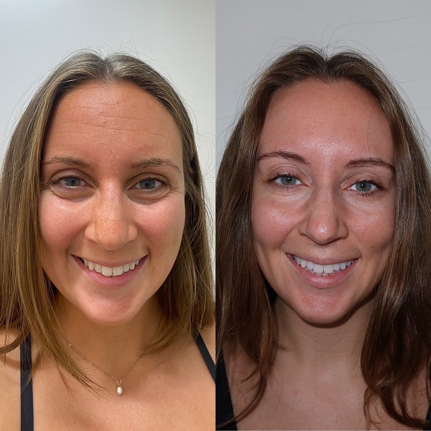 Botox Before & After