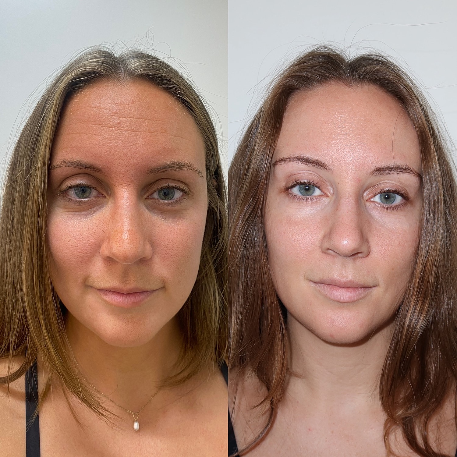 Botox Before & After