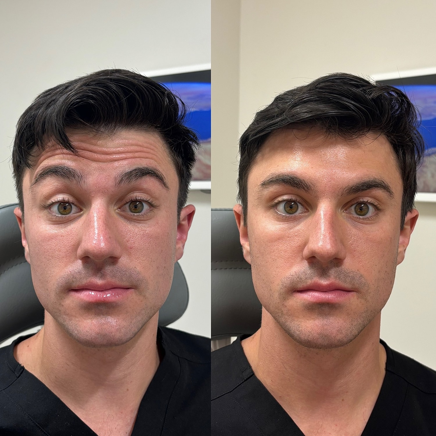 Botox Before & After