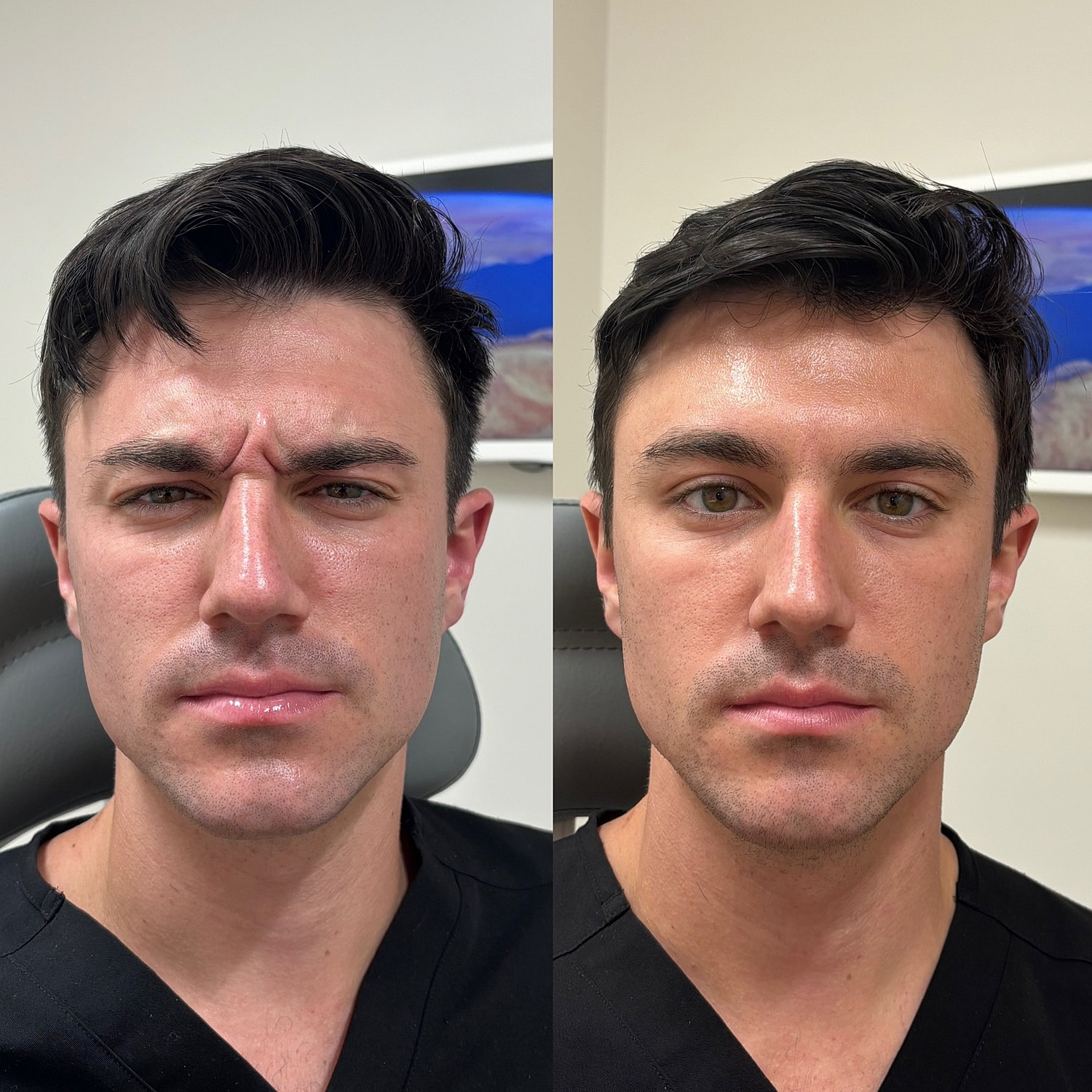 Botox Before & After