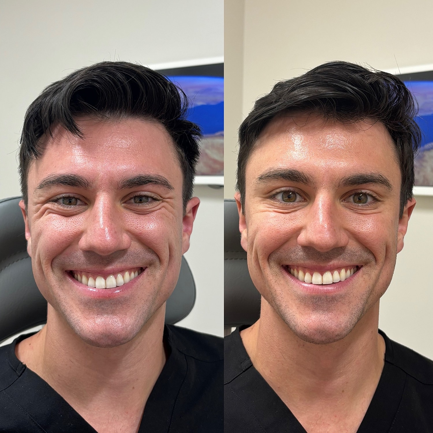 Botox Before & After