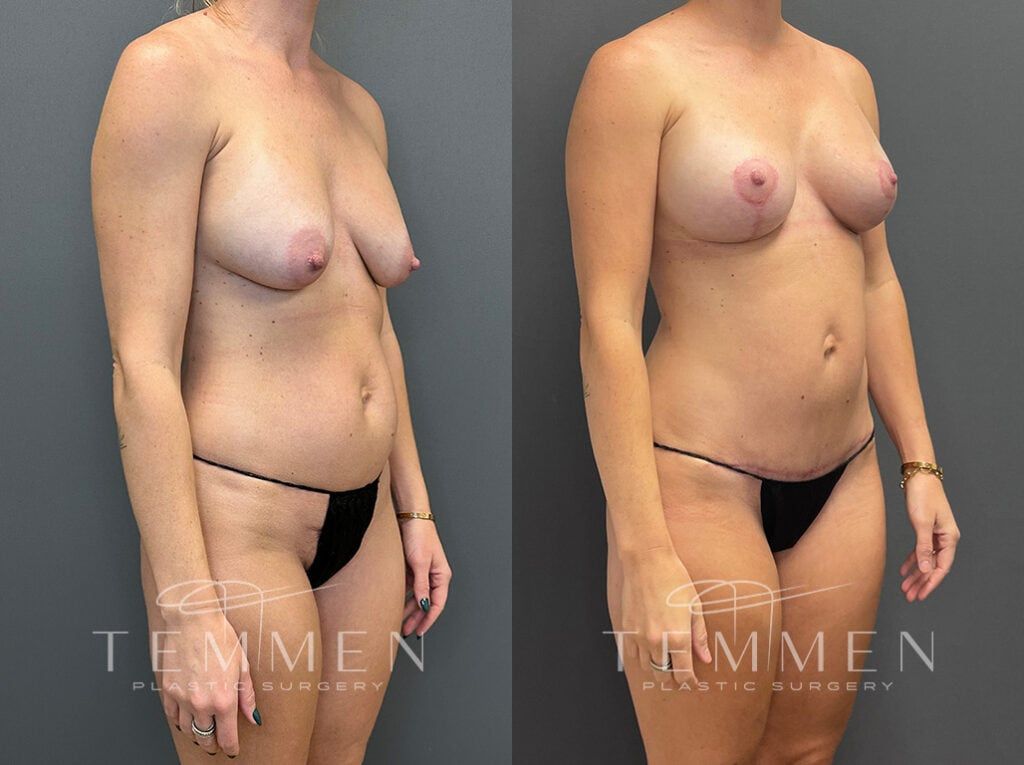 Mommy Makeover Before & After