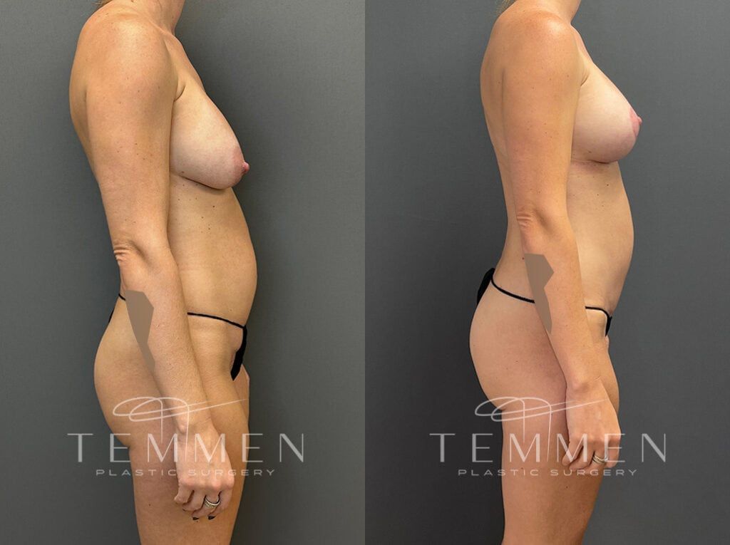 Mommy Makeover Before & After