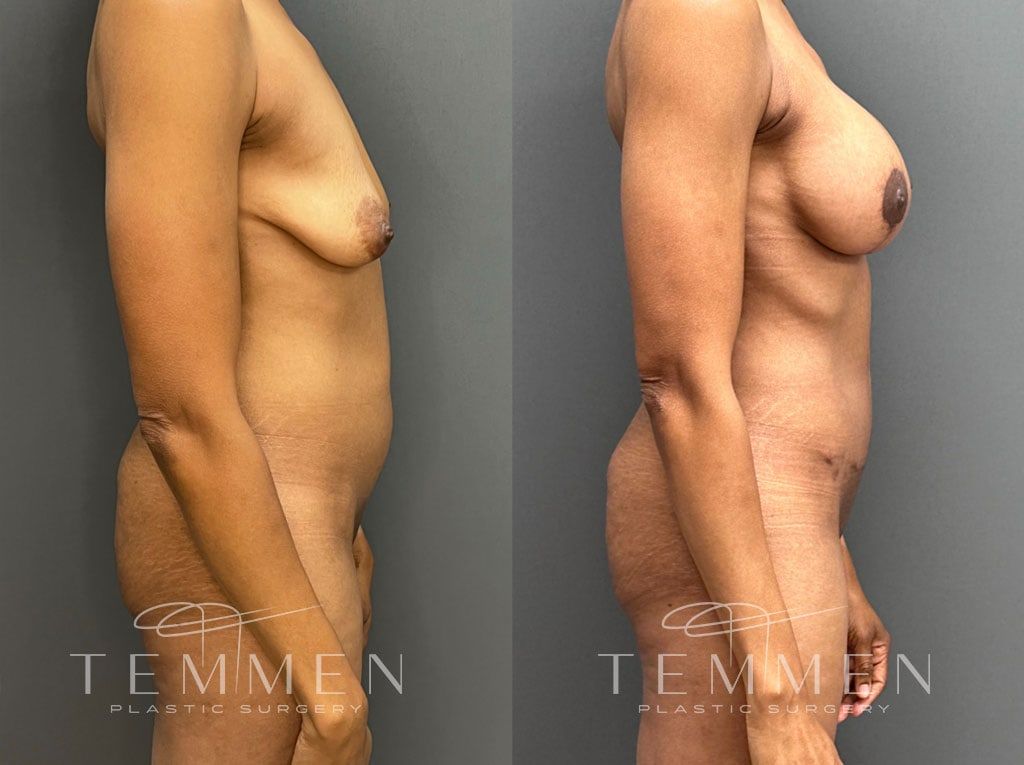 Mommy Makeover Before & After