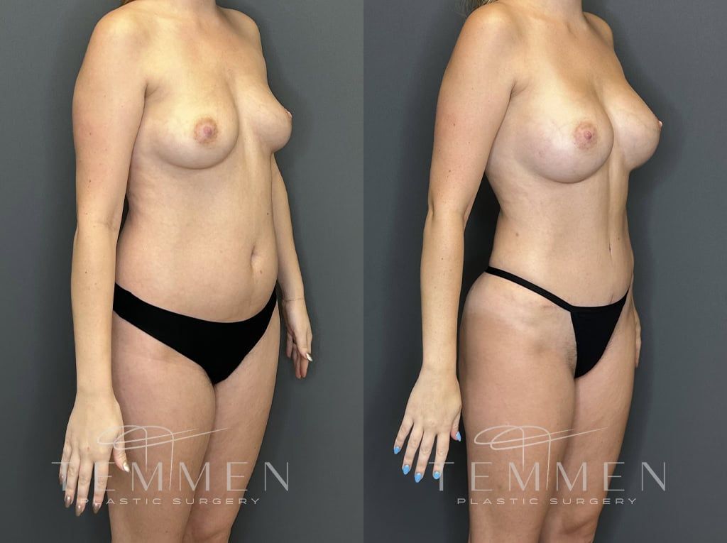 Mommy Makeover Before & After