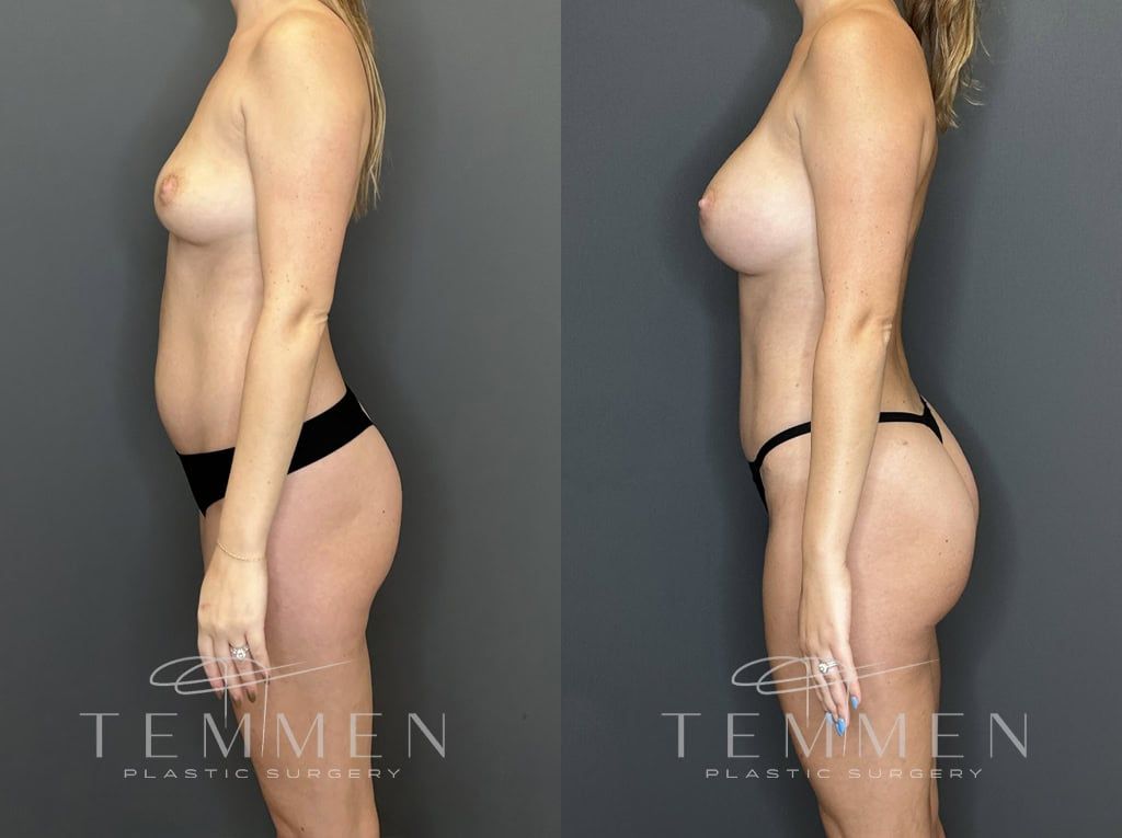 Mommy Makeover Before & After