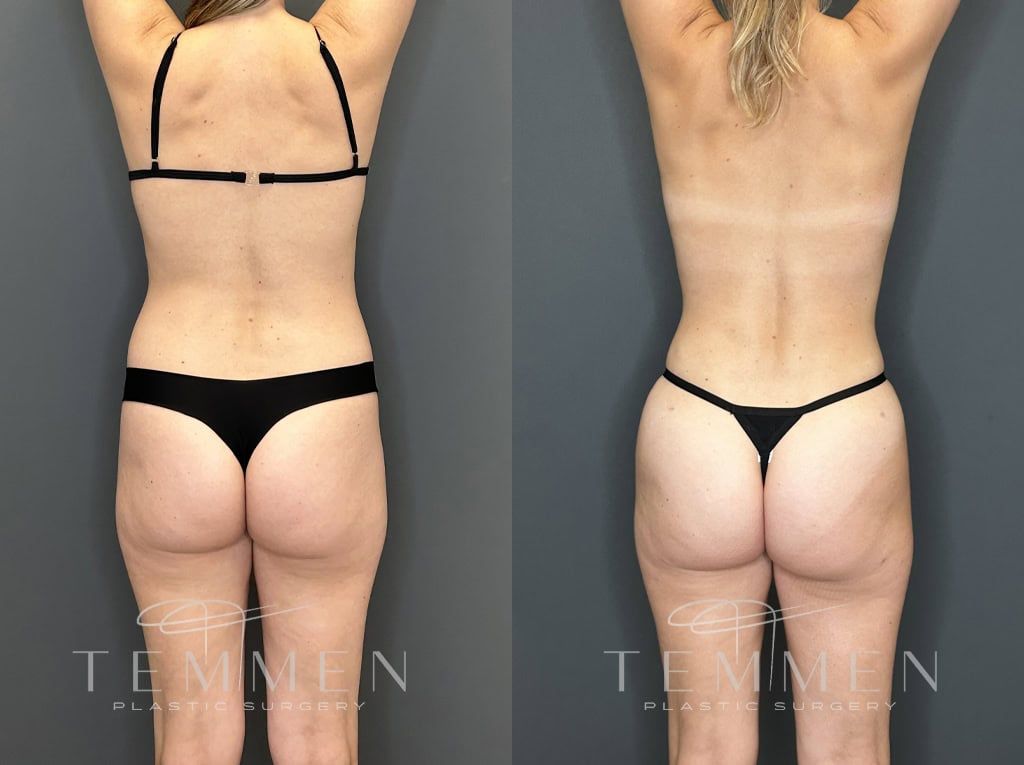 Mommy Makeover Before & After