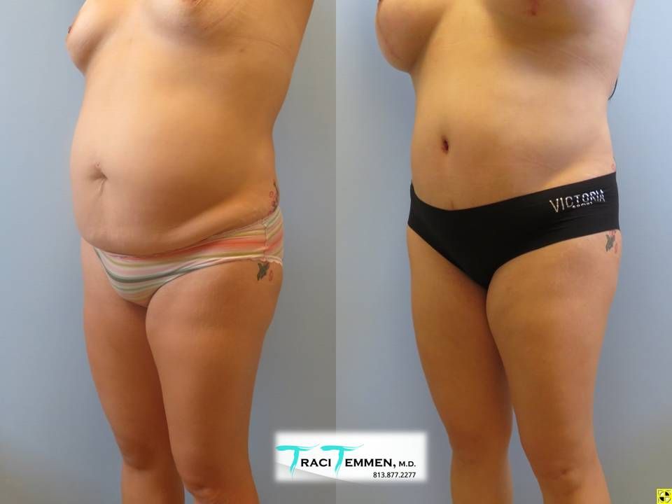 Mommy Makeover Before & After