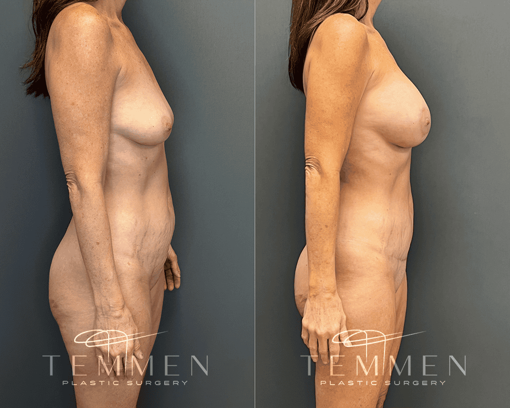 Mommy Makeover Before & After