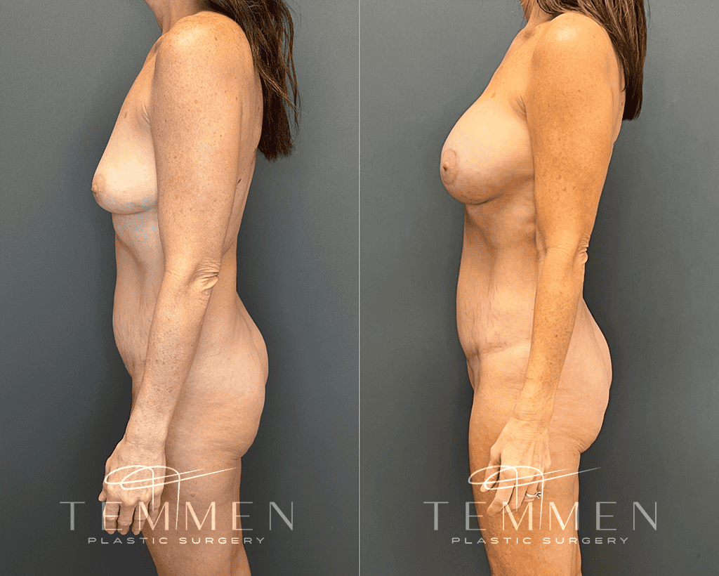 Mommy Makeover Before & After