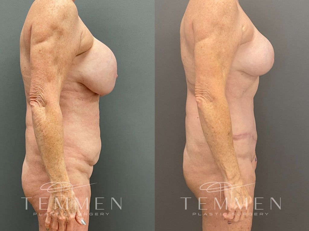 Mommy Makeover Before & After