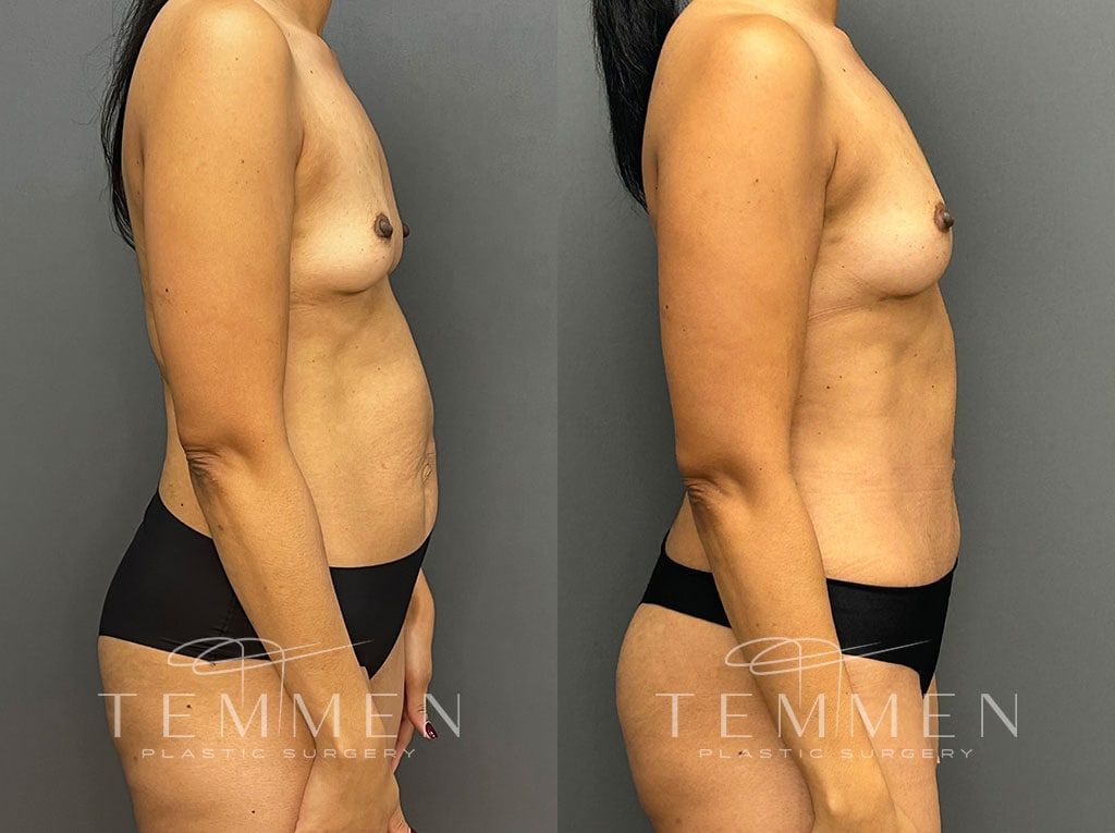 Mommy Makeover Before & After