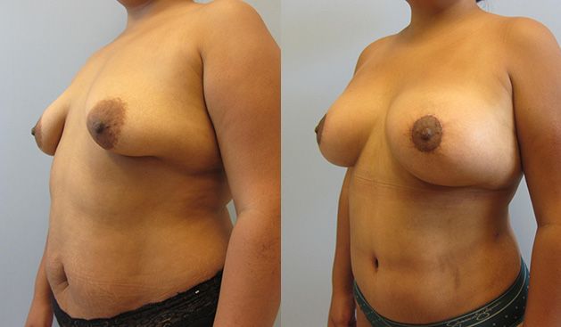 Mommy Makeover Before & After