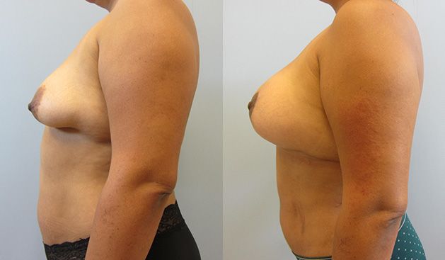 Mommy Makeover Before & After