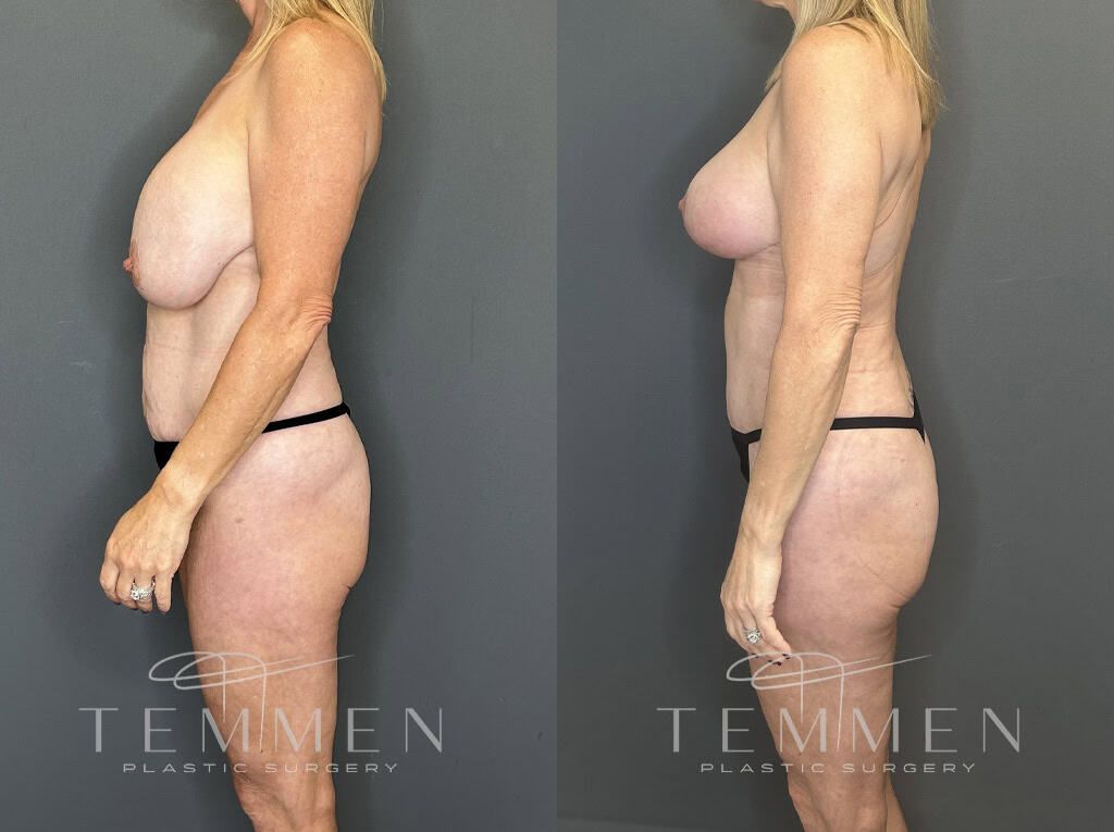 Mommy Makeover Before & After