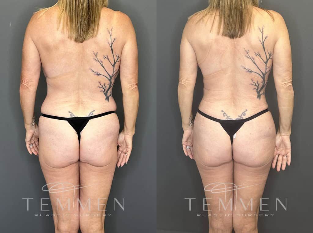 Mommy Makeover Before & After