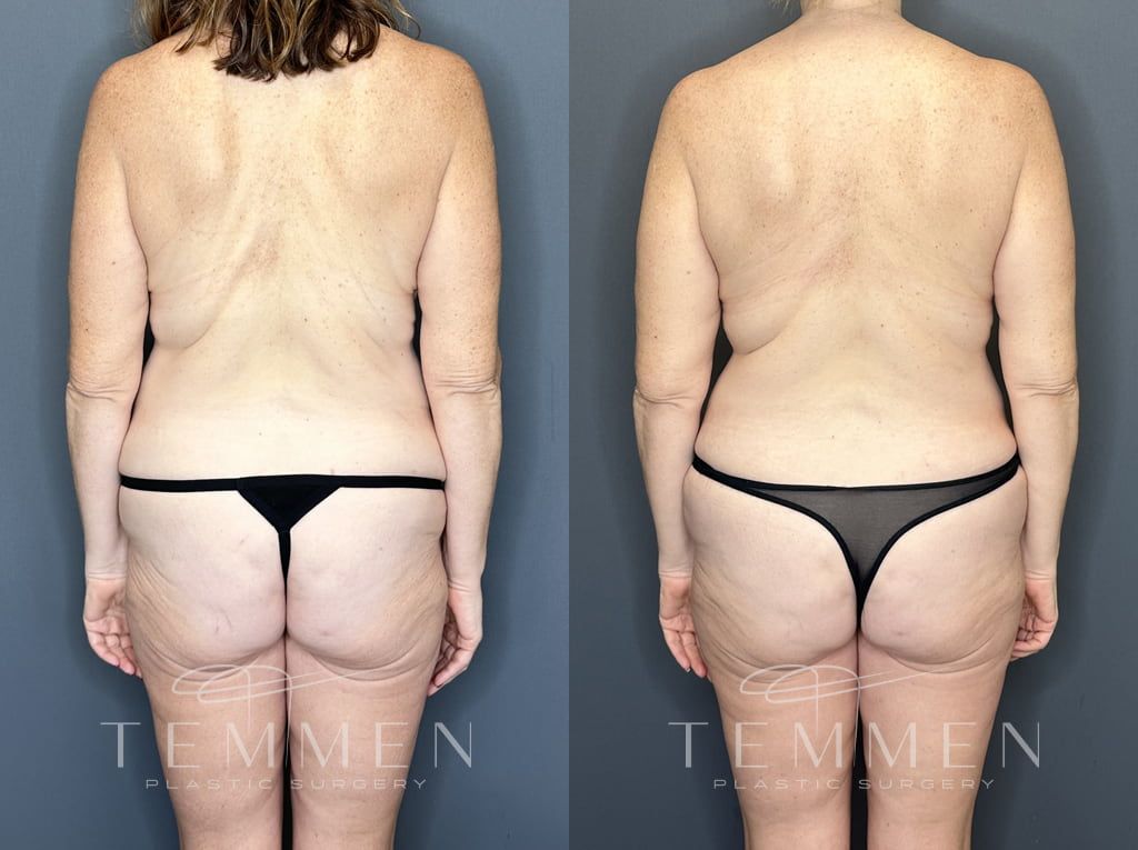 Mommy Makeover Before & After