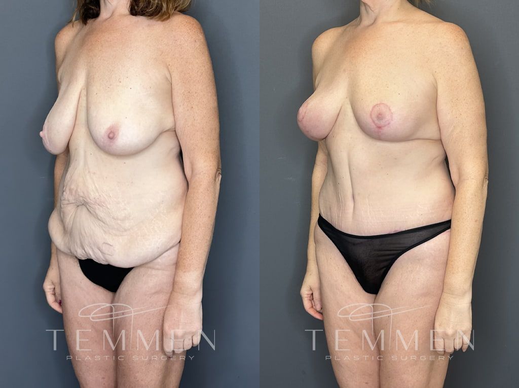 Mommy Makeover Before & After