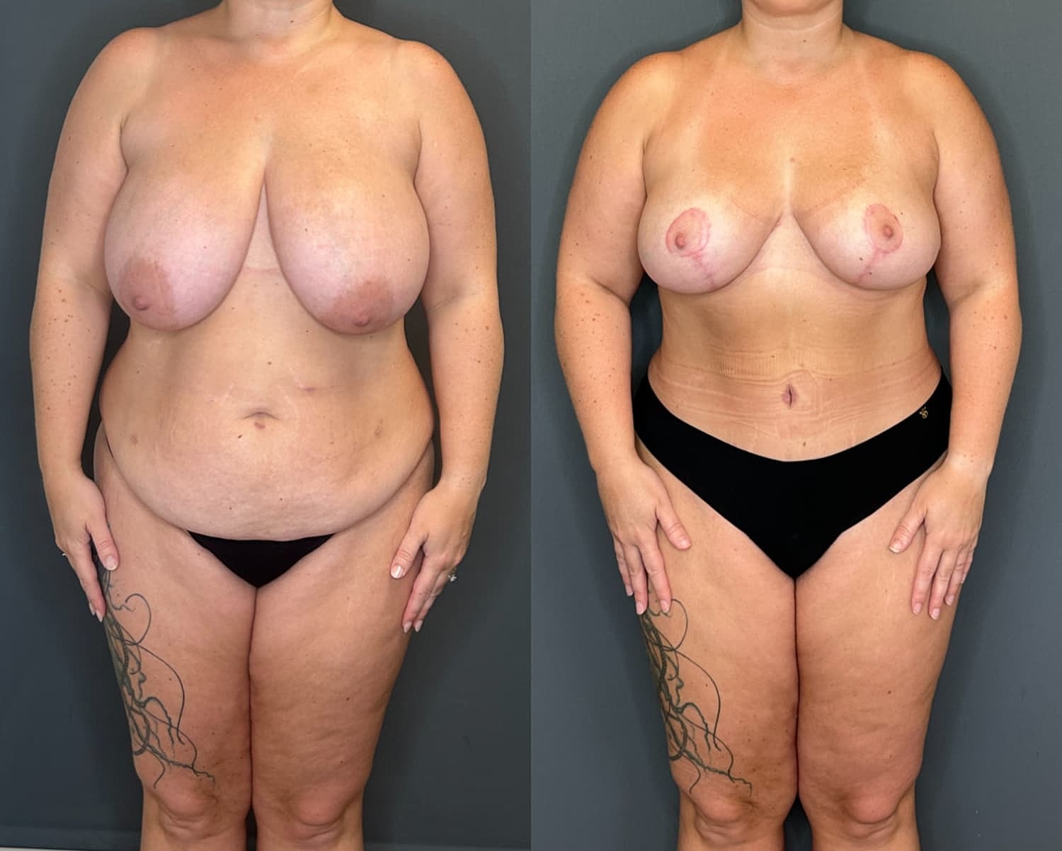 Mommy Makeover Before & After