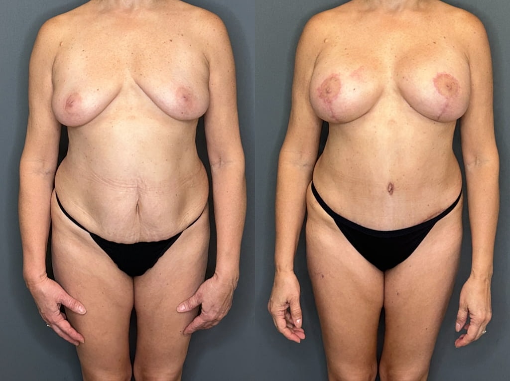 Mommy Makeover Before & After