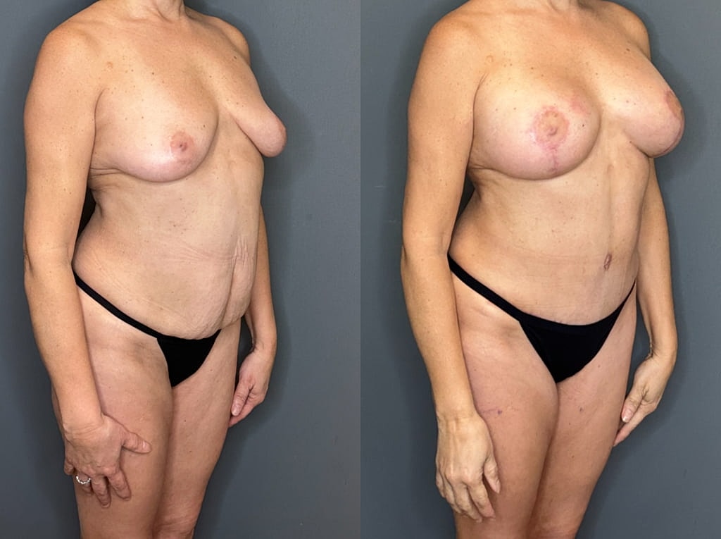 Mommy Makeover Before & After
