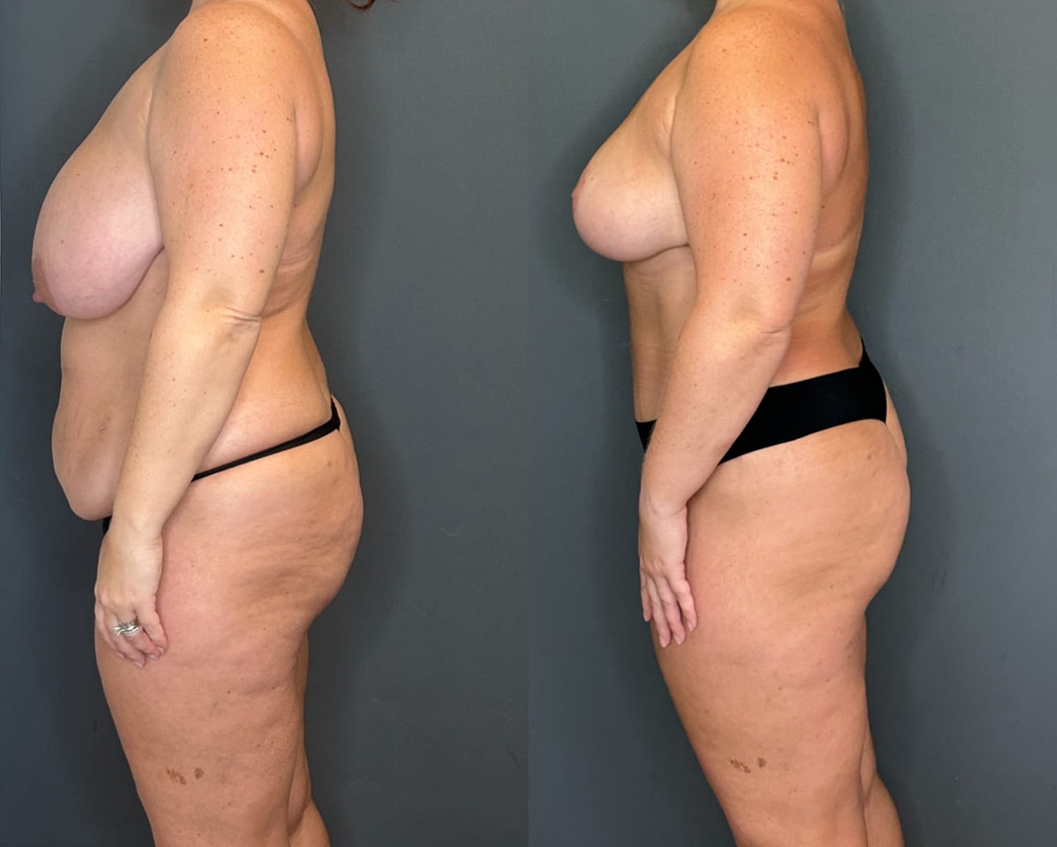 Mommy Makeover Before & After