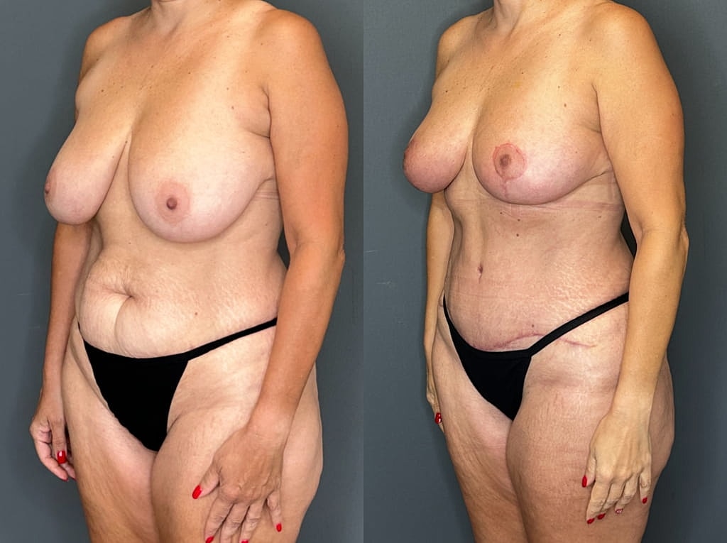 Mommy Makeover Before & After