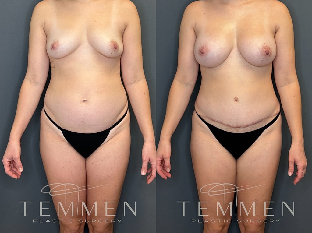 Mommy Makeover Before & After