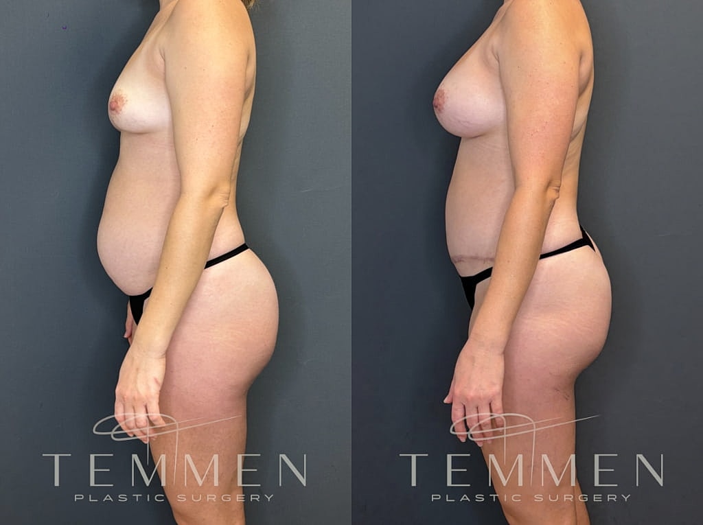 Mommy Makeover Before & After