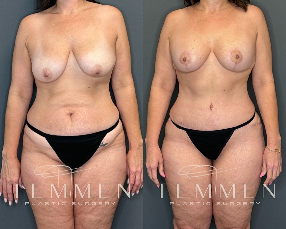 Before and after plastic surgery transformation.