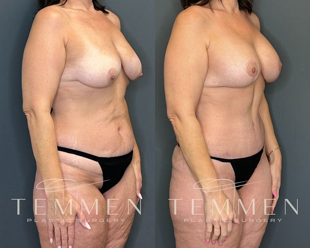 Before and after body contouring surgery images.