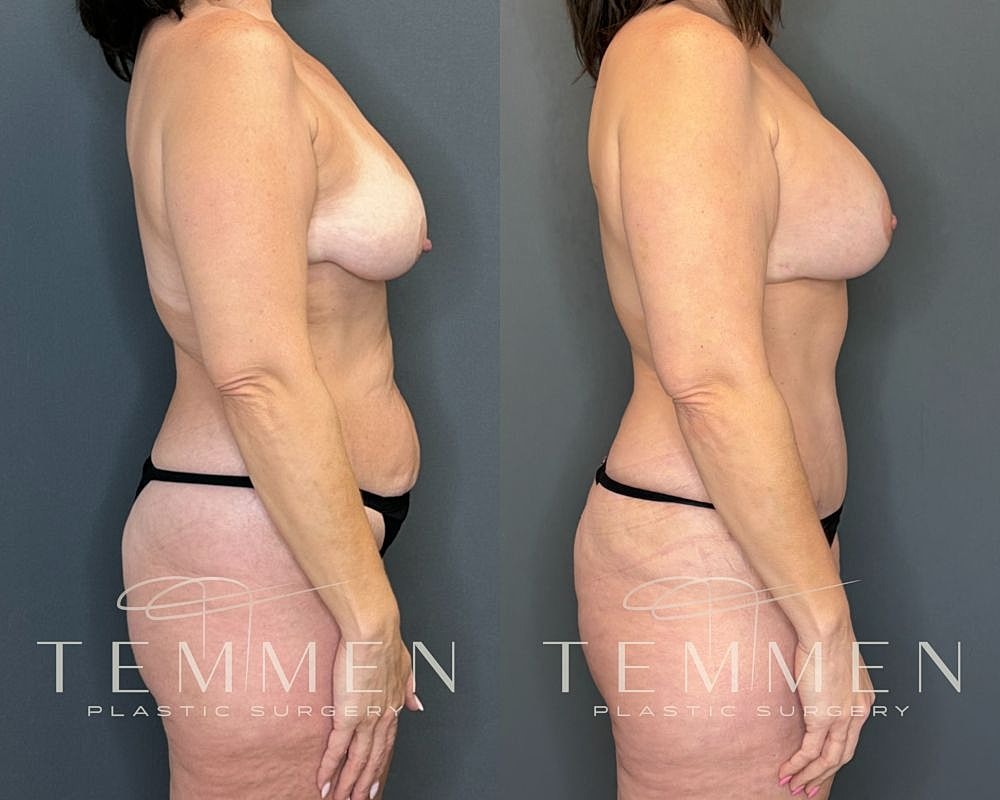 Before and after side profile of body transformation.