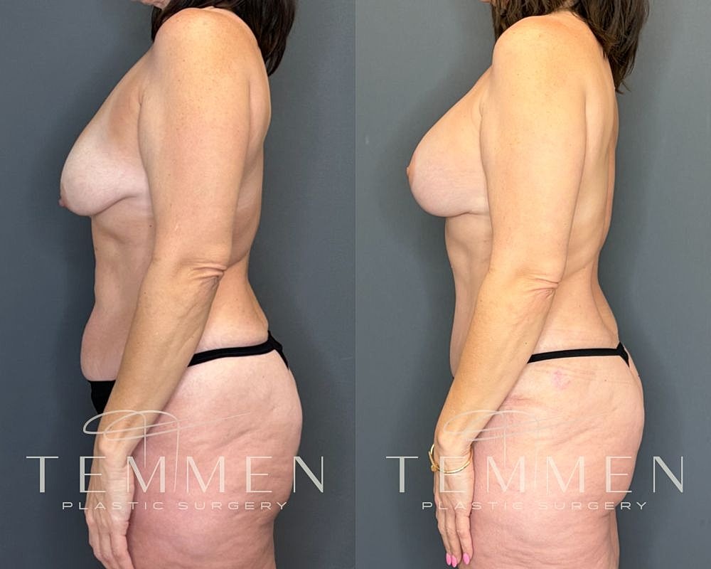 Before and after plastic surgery side view.