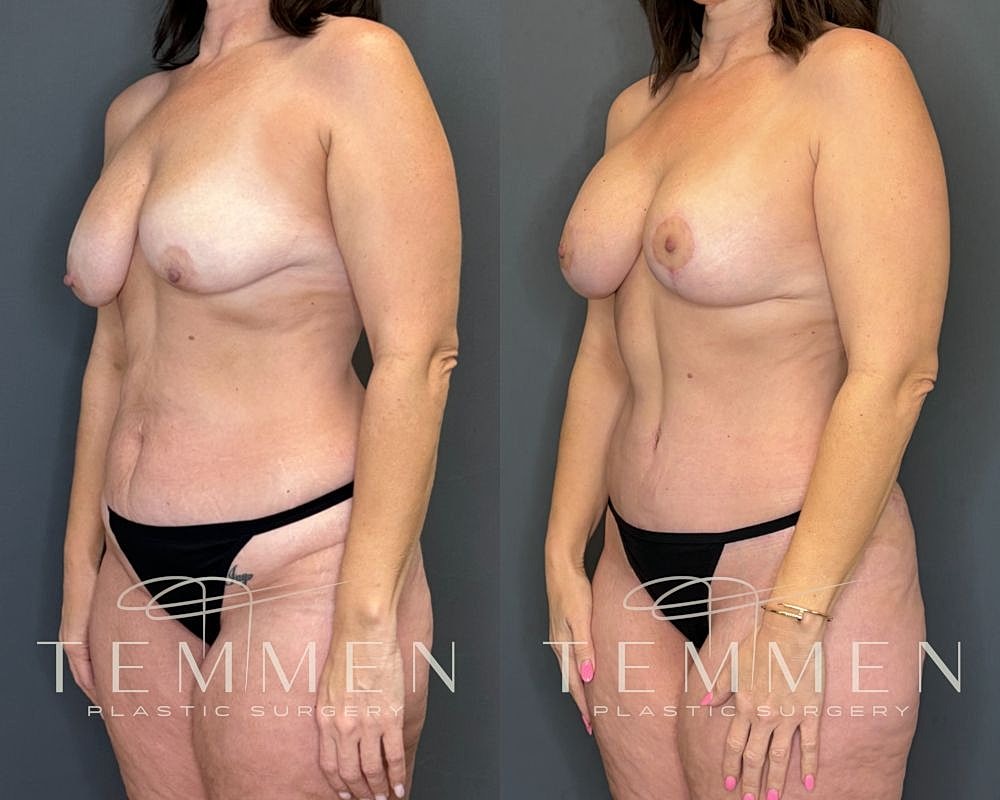 Before and after plastic surgery transformation.