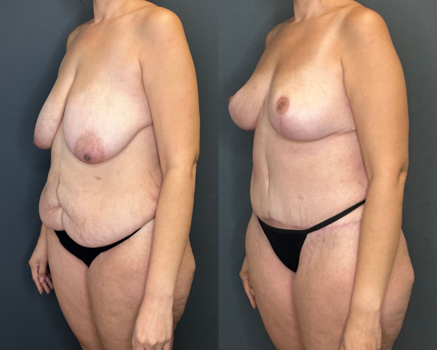 Mommy Makeover Before & After