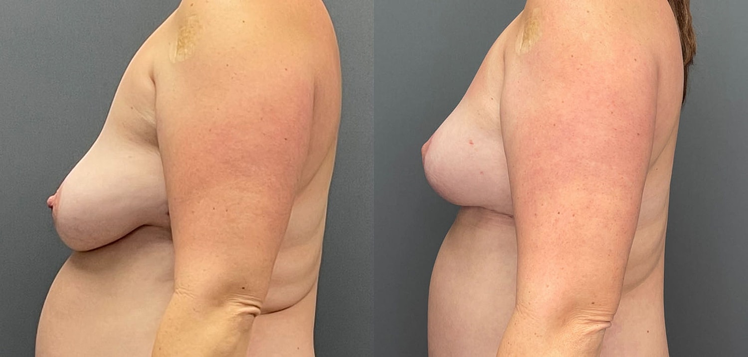 Breast Lift with Fat Transfer Before & After