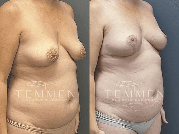 Breast Lift with Fat Transfer Before & After