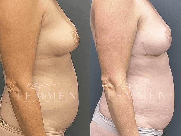 Breast Lift with Fat Transfer Before & After