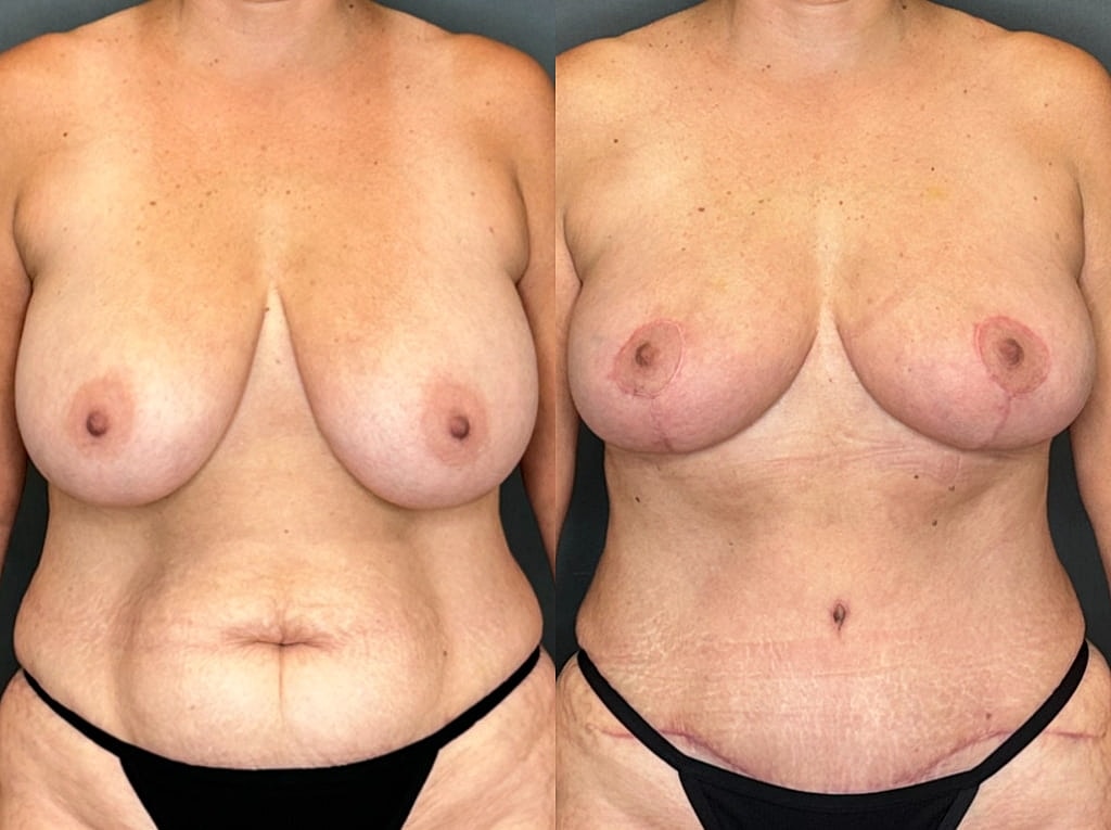 Breast Lift with Fat Transfer Before & After