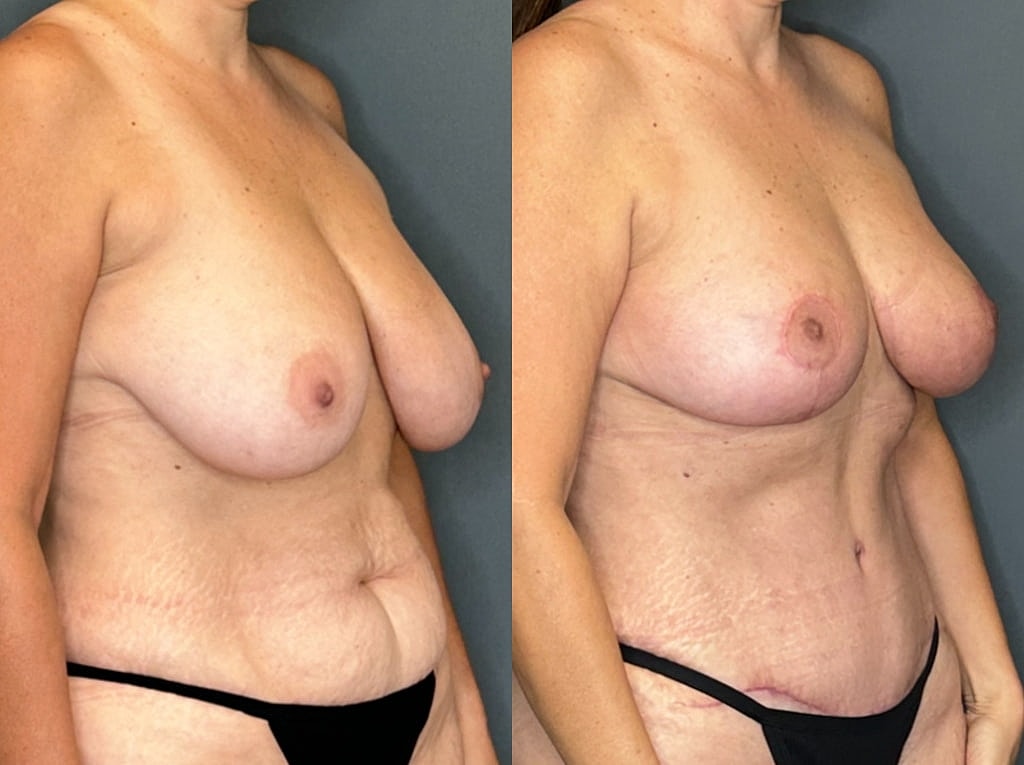 Breast Lift with Fat Transfer Before & After
