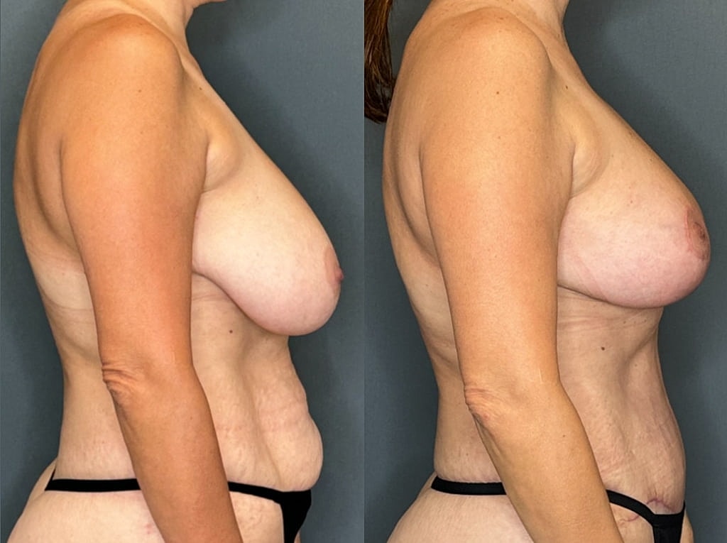 Breast Lift with Fat Transfer Before & After