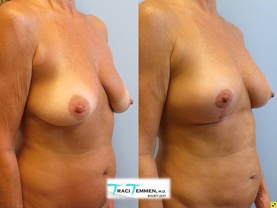 Breast Lift with Fat Transfer Before & After