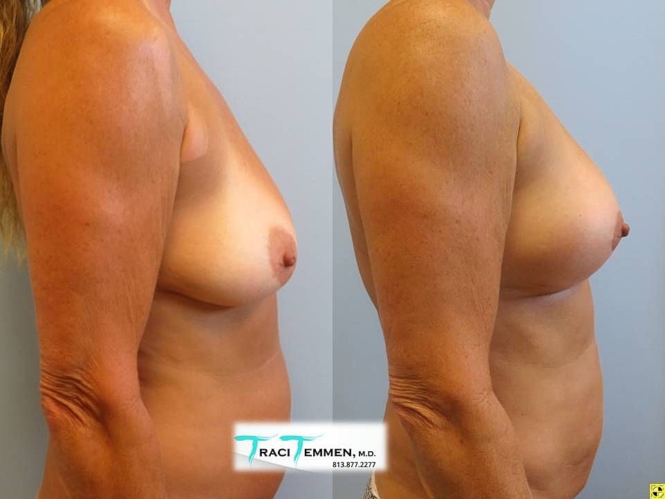 Breast Lift with Fat Transfer Before & After