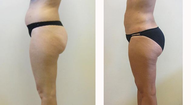Liposuction Before & After