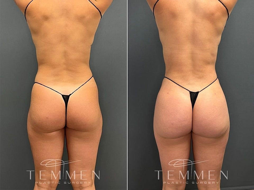 Liposuction Before & After