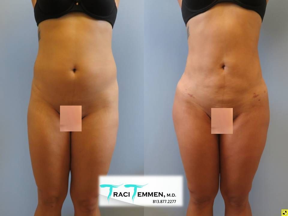 Liposuction Before & After