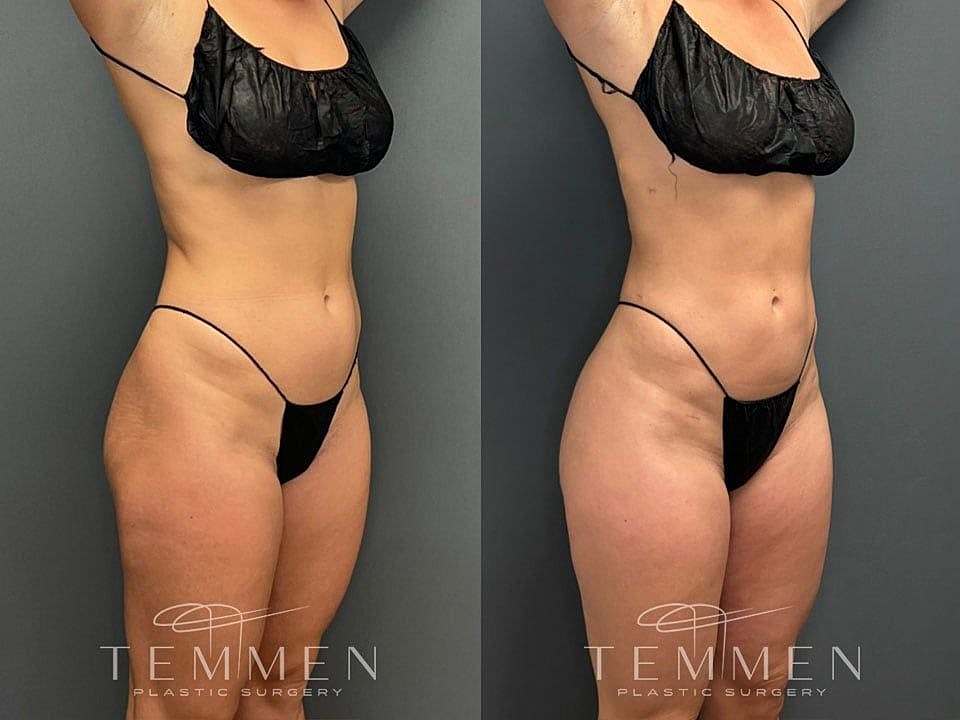 Liposuction Before & After